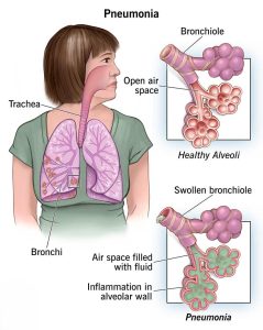 pneumonia disease